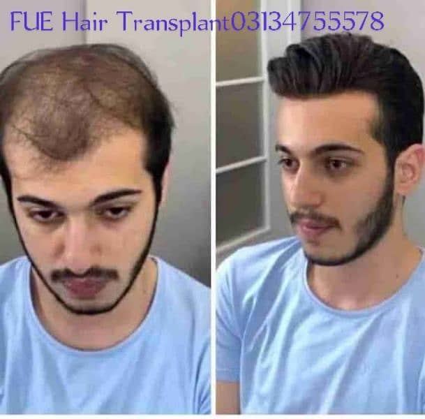 hair units hair transplant services PRP 4