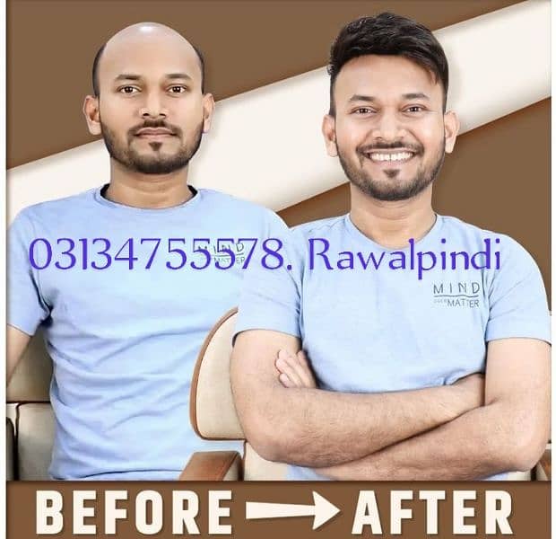 hair units hair transplant services PRP 5