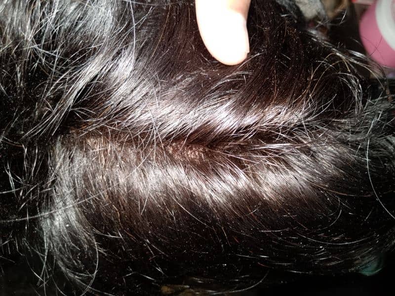 Hair patch 1