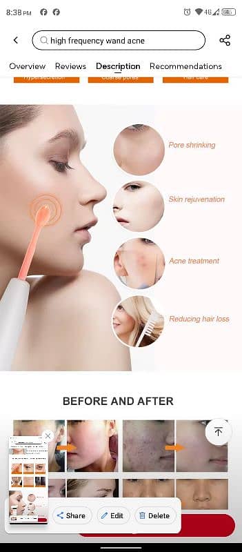 Anti Aging Acne Treatment Machine 1