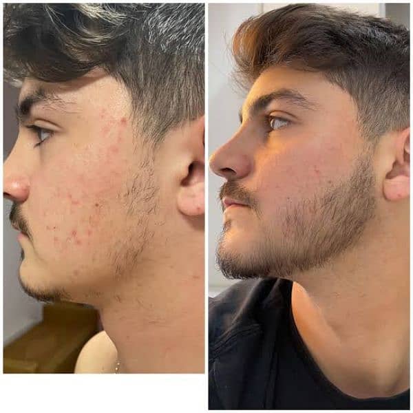 Patchy Beard & Pachy Hair Complete 100% Solution 2