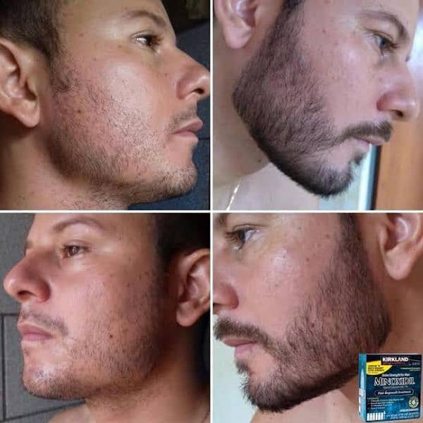 Patchy Beard & Pachy Hair Complete 100% Solution 3