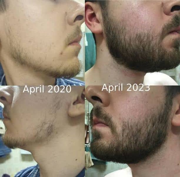 Patchy Beard & Pachy Hair Complete 100% Solution 1