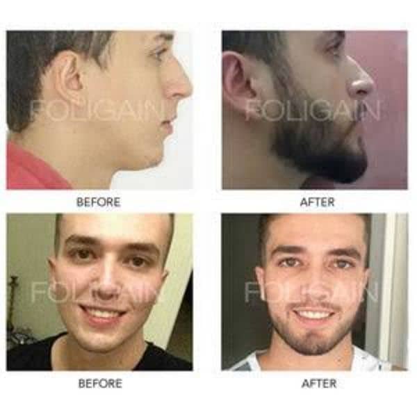 Patchy Beard & Pachy Hair Complete 100% Solution 8