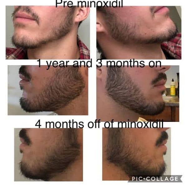 Patchy Beard & Pachy Hair Complete 100% Solution 9