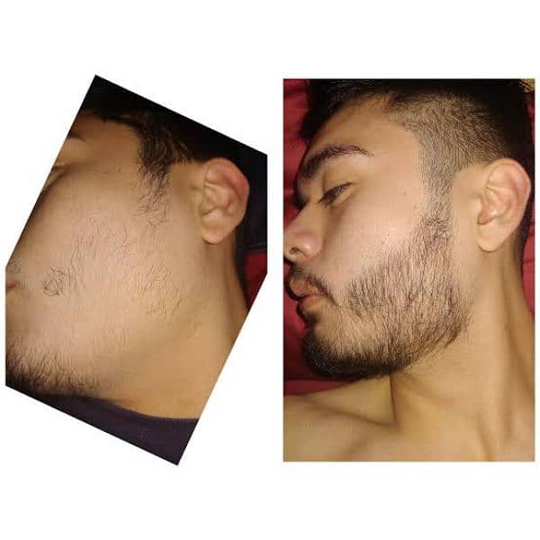 Patchy Beard & Pachy Hair Complete 100% Solution 10