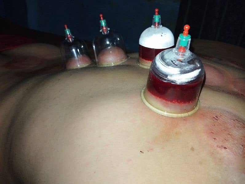 Professional hijama at your home 2