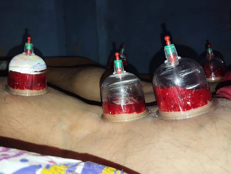 Professional hijama at your home 3