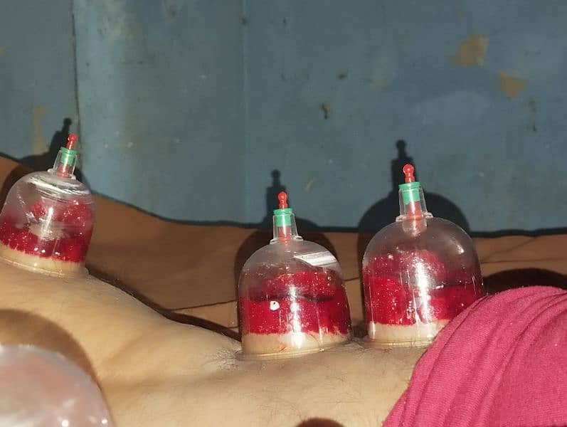 Professional hijama at your home 4