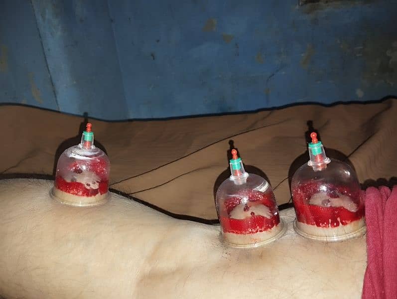 Professional hijama at your home 5