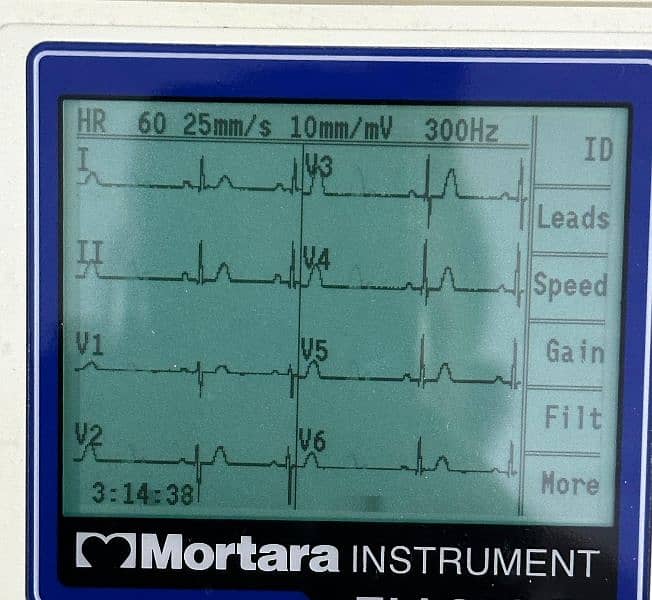 ECG Machines (03, 06 & 12 Channel) Accurate & Reliable ECG 5