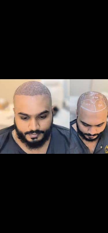 hair care hair transplant 100% reault sialkot 0