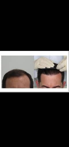 hair care hair transplant 100% reault sialkot