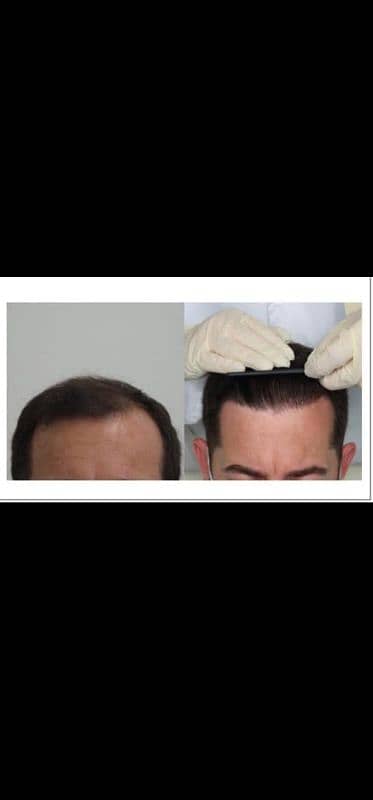 hair care hair transplant 100% reault sialkot 1