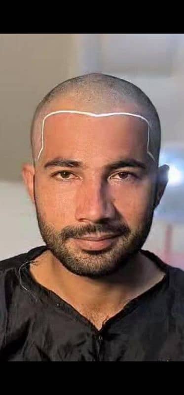 hair care hair transplant 100% reault sialkot 2