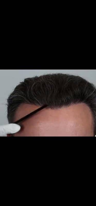 hair care hair transplant 100% reault sialkot 3