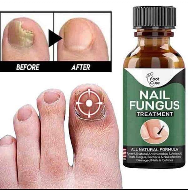 FAST NAIL FUNGAL TREATMENTS ( NAIL REPAIR ) 1