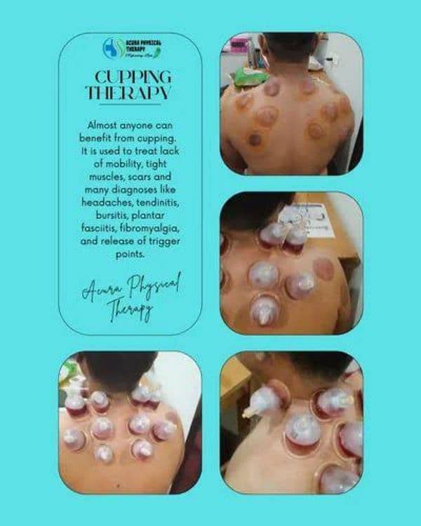 Hijama At Home 0