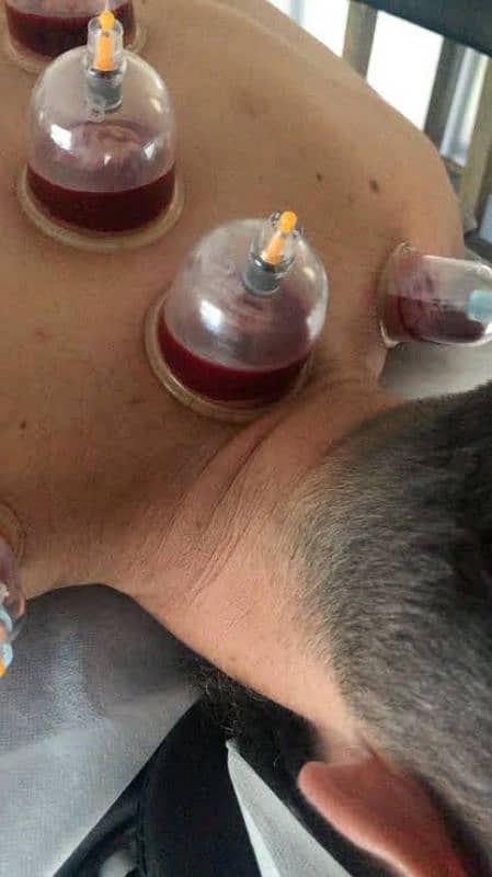 Hijama At Home 2