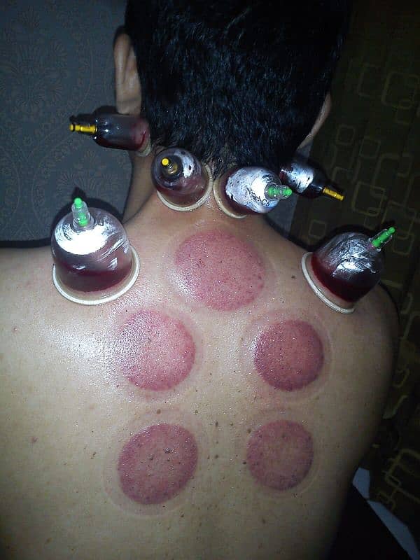 Hijama At Home 3