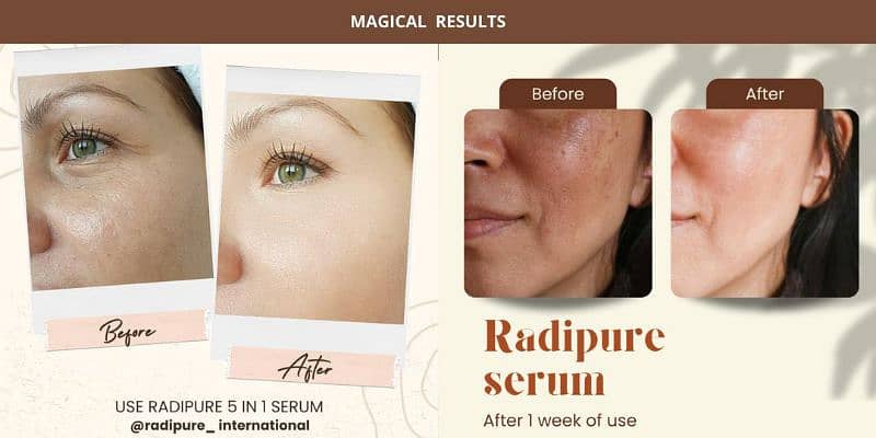 Anti-Acne Hyaluronic Acid Serum 1