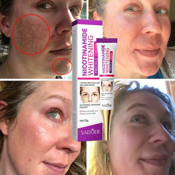 Nicotinamide Whitening Freckles Cream Remove Melasma Dark Spot Acne 7