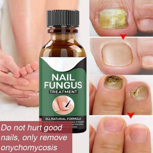 Nail Fungus Treatment Gel | Onychomycosis & Paronychia Relief 1