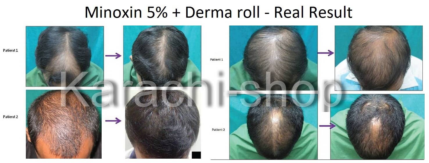 Derma Roller 540 Micro Needle Skin Therapy 0.50mm with Minoxin 5% Hai 1