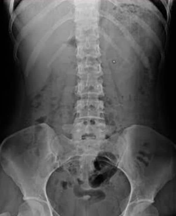 Digital X-Ray Machine 320mA 0