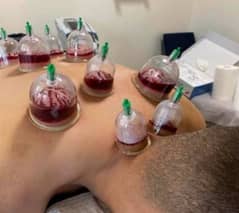 Hijama Cuping home services only men 300 per point