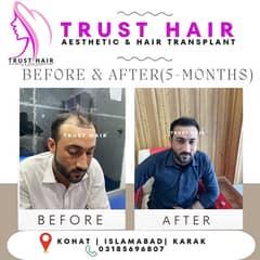 Trust Hair Transplant