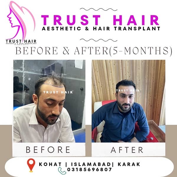 Trust Hair Transplant 0