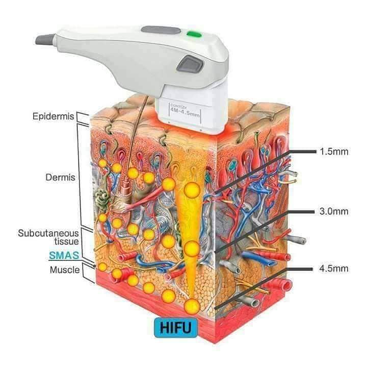 Hifu 7D Skin Tightening and Contouring  Machine 3