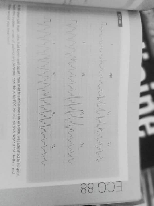 ECG problem interpretation practice 2