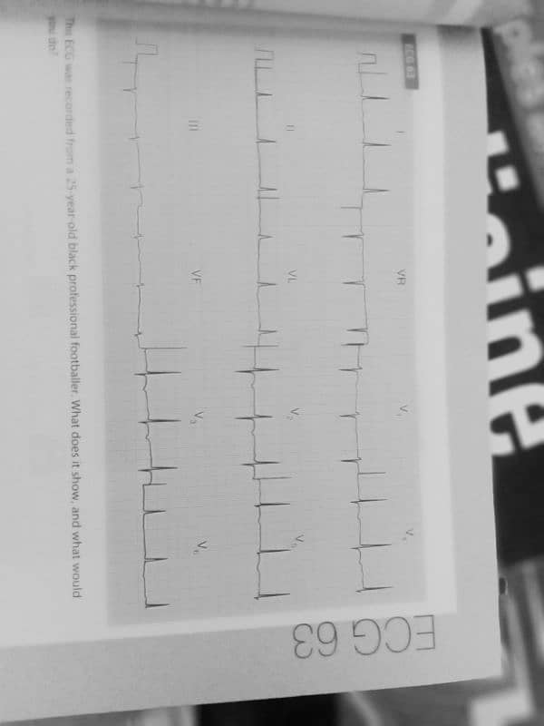 ECG problem interpretation practice 3