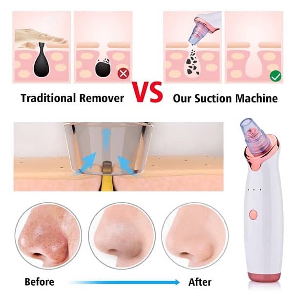 Vacuum Blackhead remover 1