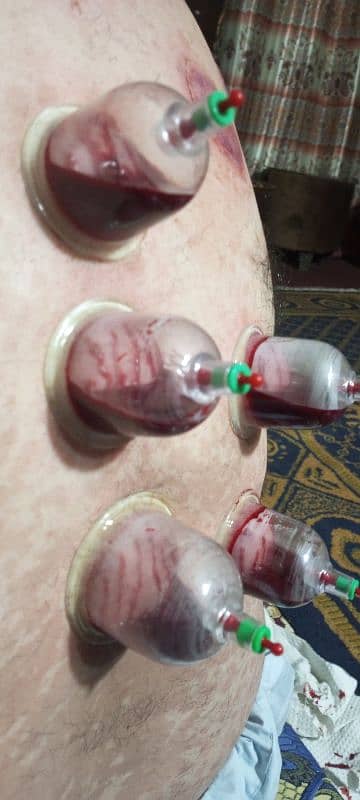 AlHijama center **RS 250 4