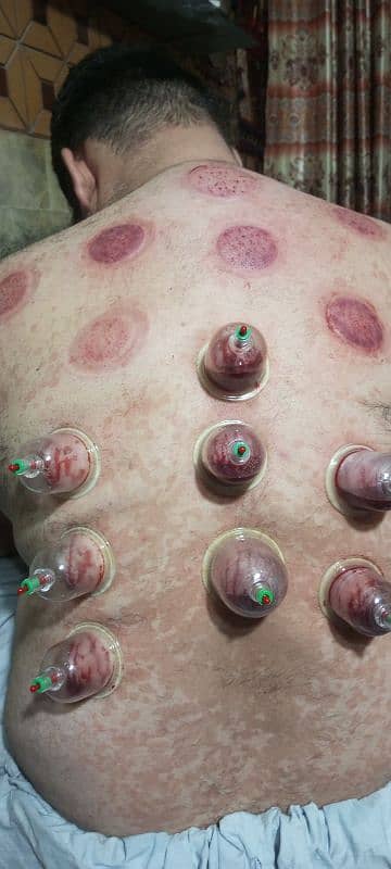 AlHijama center **RS 250 5