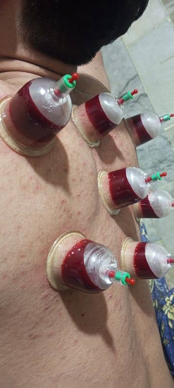 AlHijama center **RS 250 6