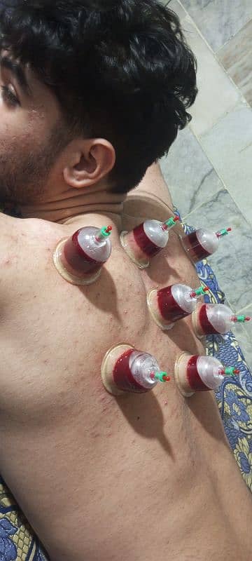 AlHijama center **RS 250 7