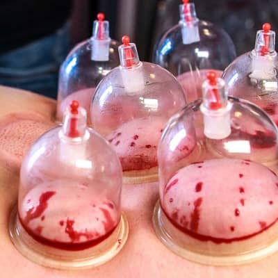 Hijama (cupping therapy) 03434041561