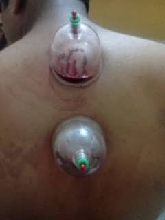 Hajama treatment