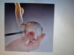 chinese fire cupping