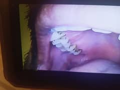 Endoscopy Camera