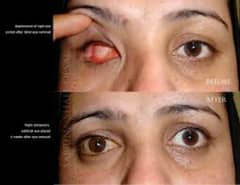 Artificial Eye