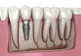 Dental