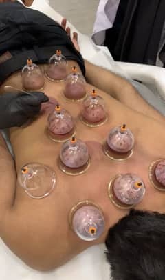 Hijama