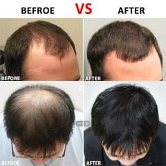 Derma Roller