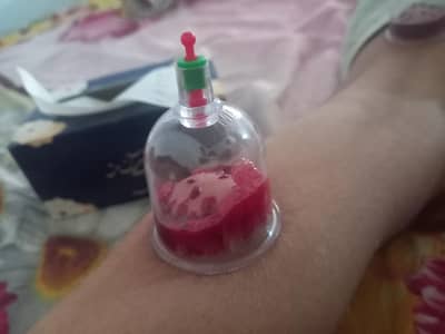 Hijama service at home and hijama cups