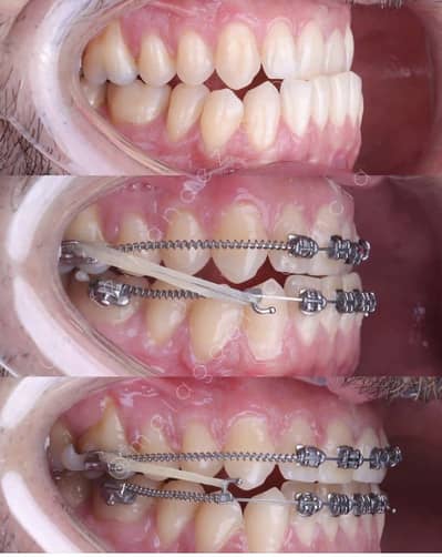 Clear dental aligners and fixed braces